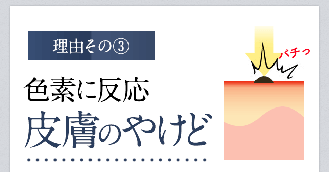 脱毛が痛い理由③皮膚のやけど